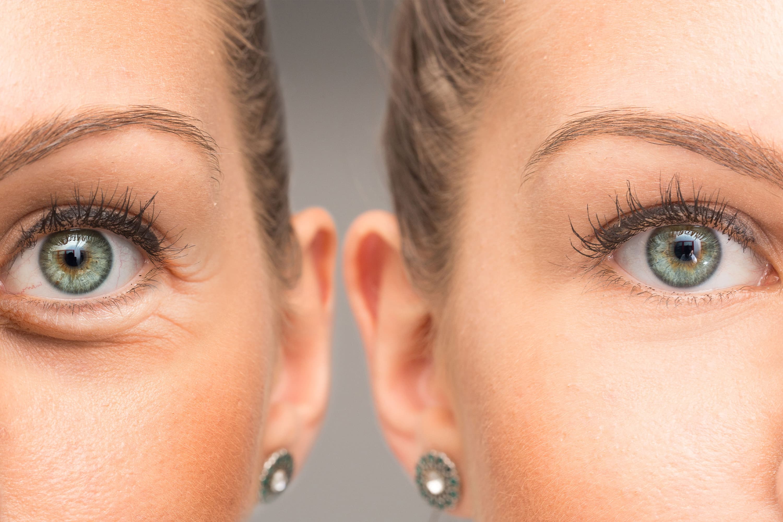 Dermal Fillers​ - Las Cruces, NM