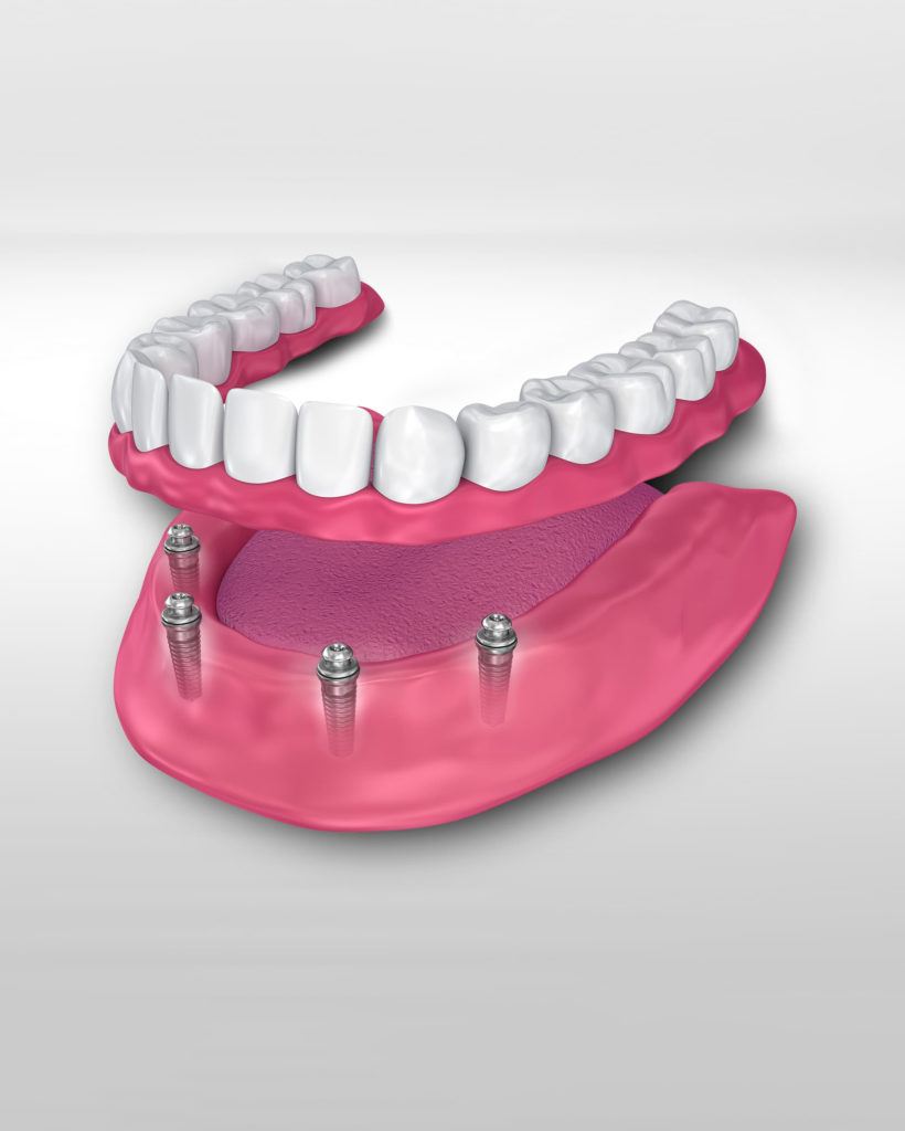 Implant supported dentures - Las Cruces, NM