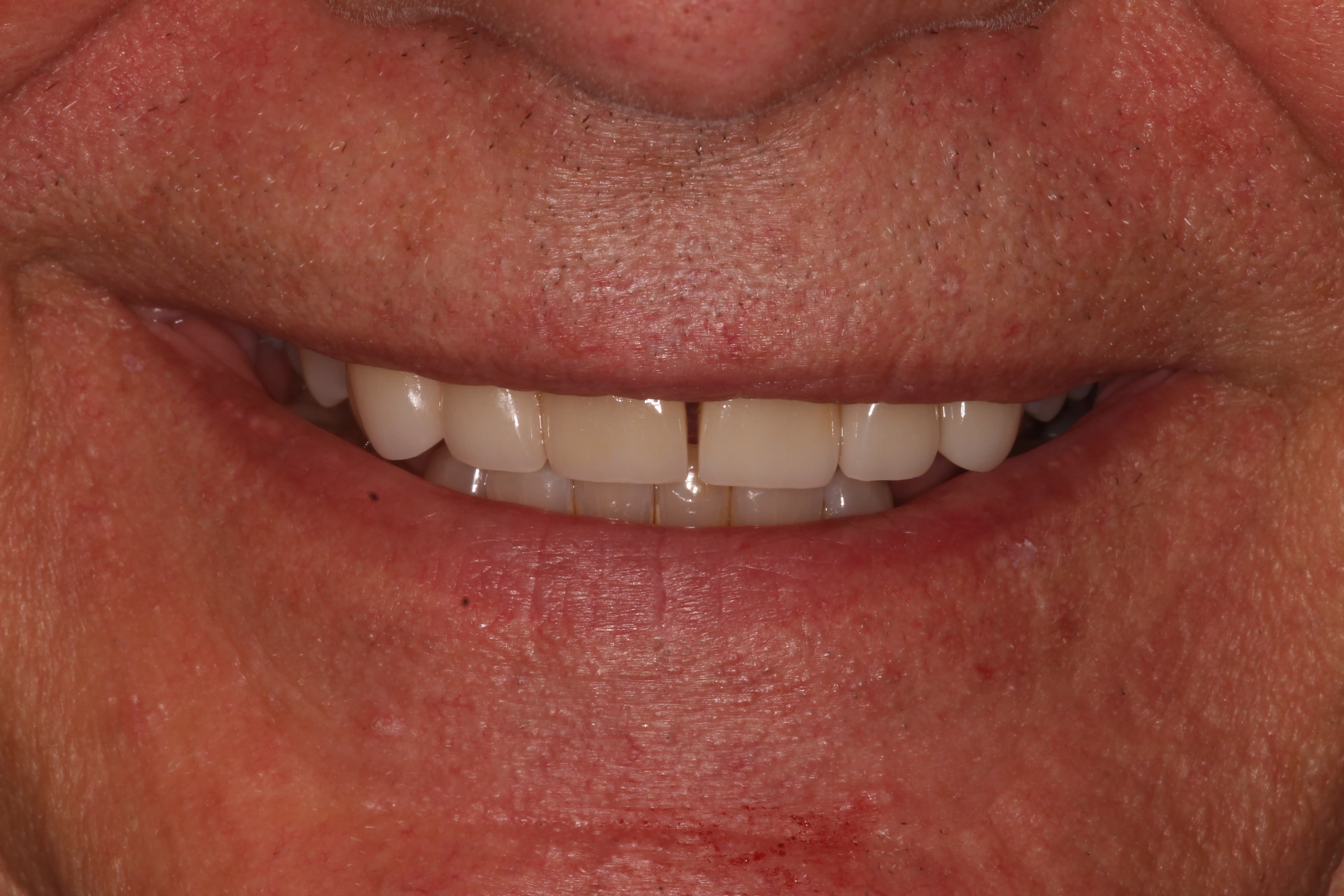 Pokluda, Vincent cosmetic dentistry After - Las Cruces, NM