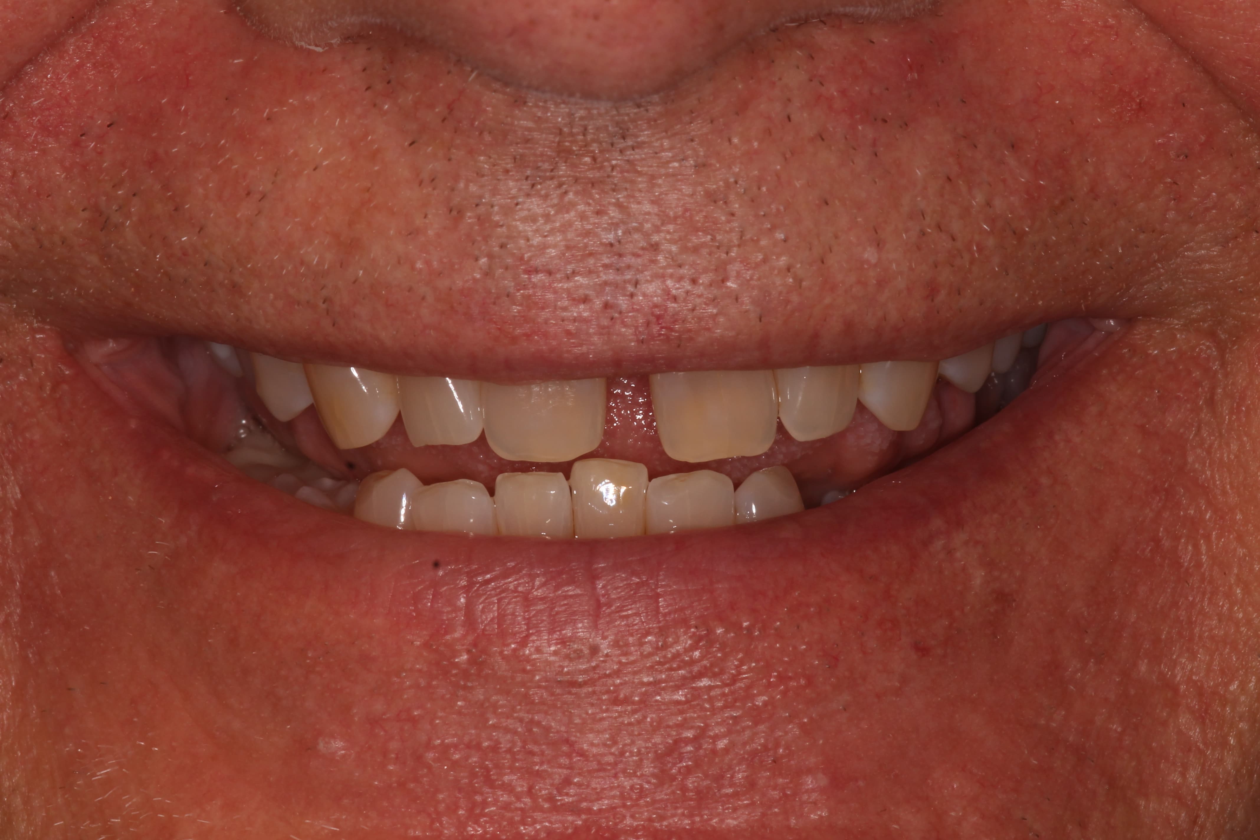 Pokluda, Vincent cosmetic dentistry Before- Las Cruces, NM