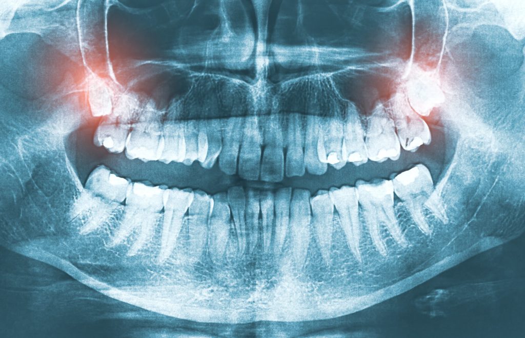 Dental X-Rays​ - Las Cruces, NM