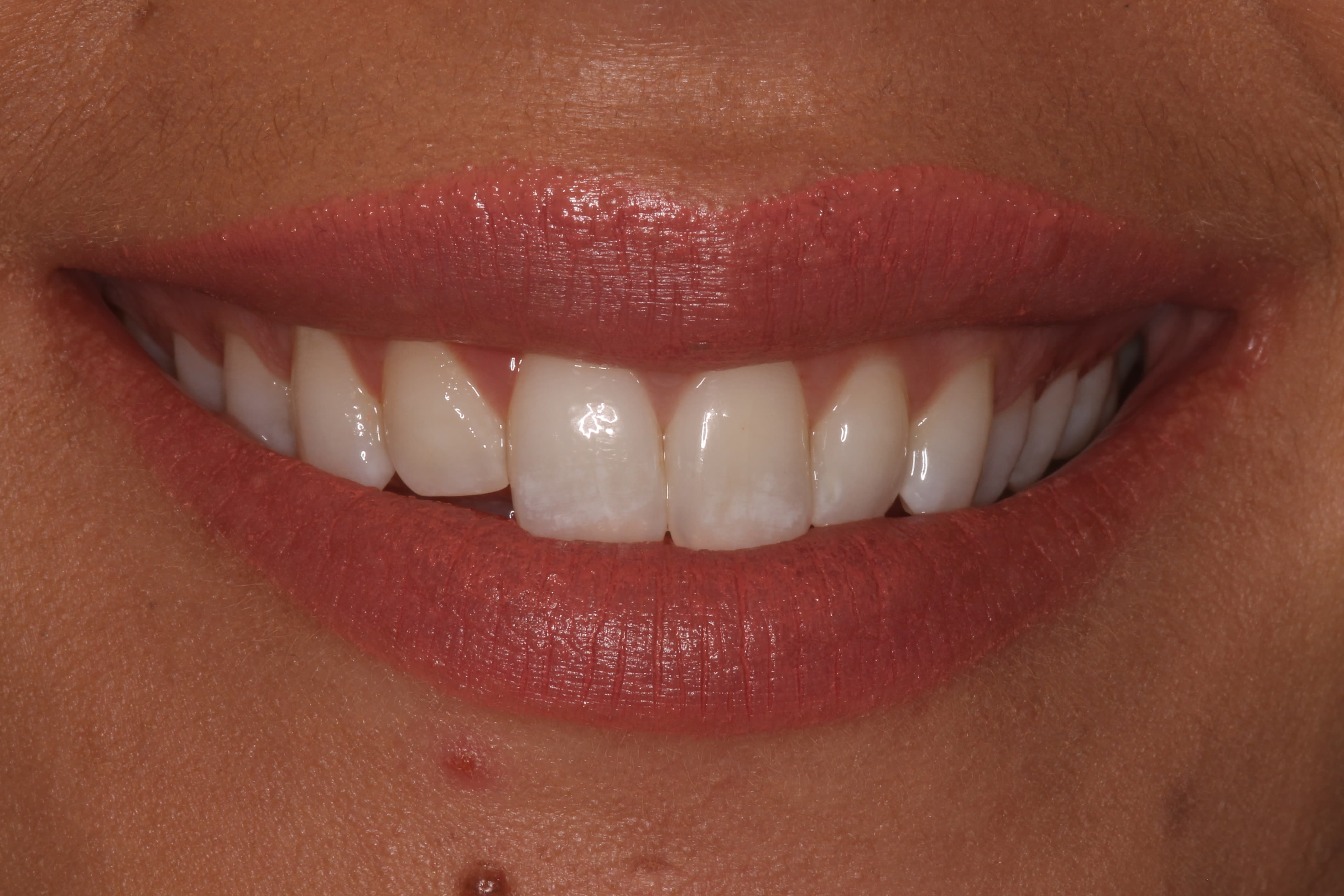 angela cosmetic dentistry before - Las Cruces, NM