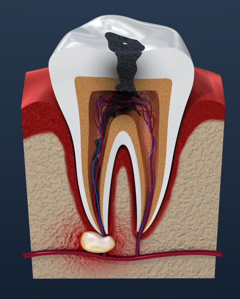 root canal - Las Cruces, NM