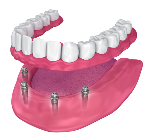 Full Arch Dental Implants - Brightstar Dental