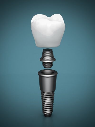 Dental Implant - Las Cruces, NM